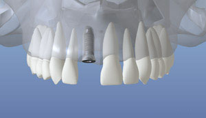 A representation of the healed jaw bone after placement of the dental implant