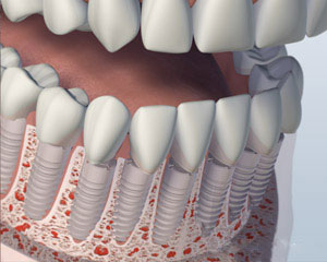 A mouth showing the lower jaw with all the teeth as individual implants