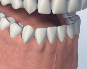 A mouth showing the healed lower jaw after individual implants were placed