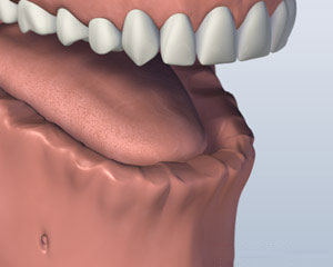 Before Bar Attachment Denture