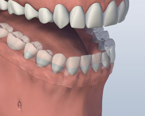 Denture Attached