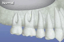 Sinus Lift Animated Gif