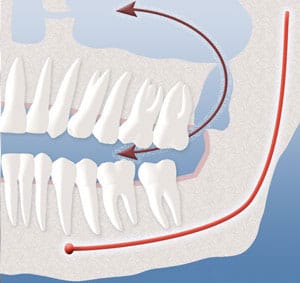 A diagram showing the opening that can occur between your mouth and sinuses