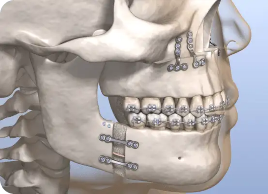 3D model showing oral and maxillofacial surgery treatment
